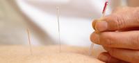 Acupuncture Group - HALF PRICE!