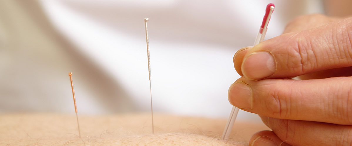 Acupuncture is available at Tavistock Physio Clinics